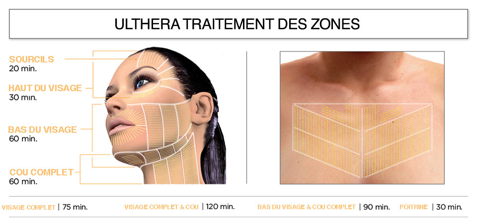 Ulthera-zones