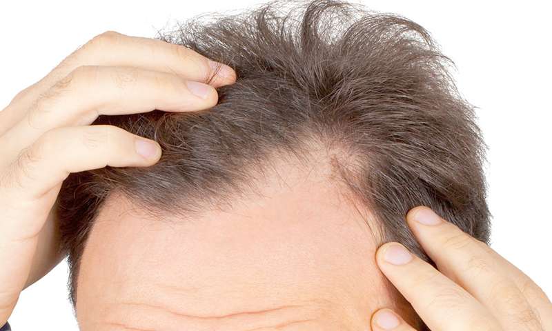 Hair Grafts | Leman Aesthetic Clinic