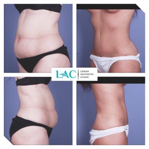 Abdominoplastie