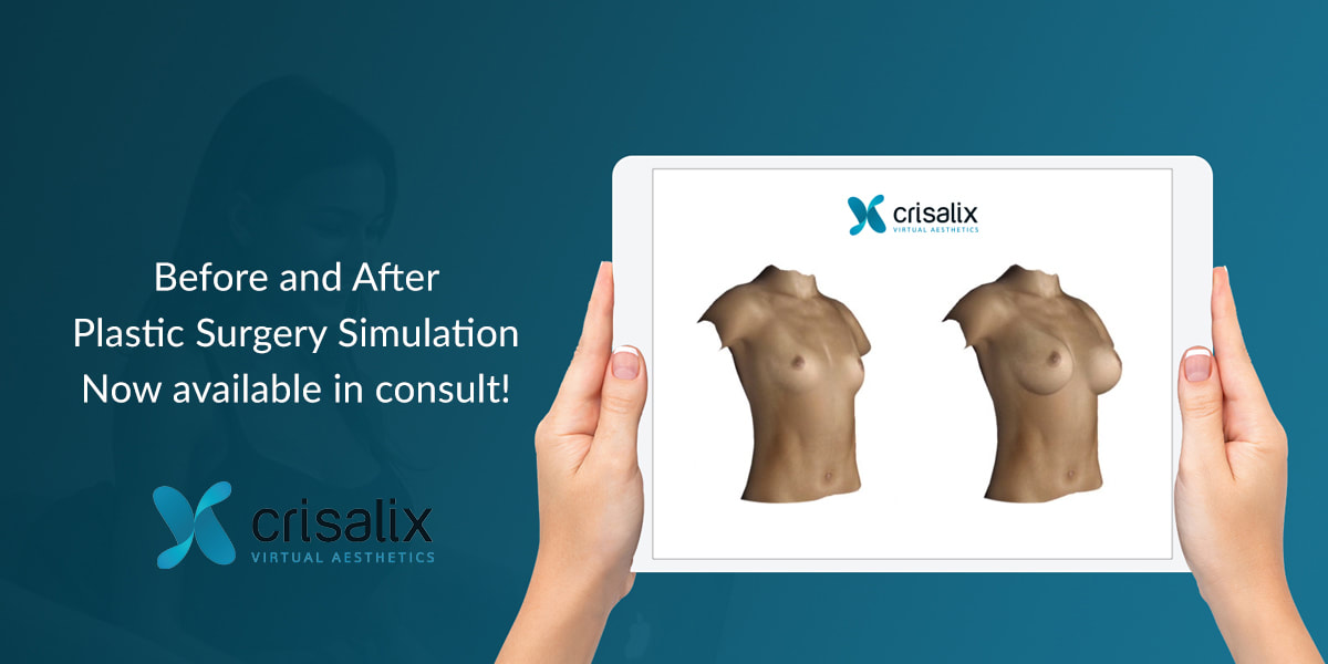 Tummy tuck with Crisalix 3D simulation, Clinimedspa