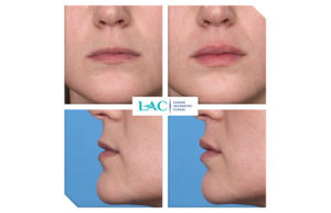 Restauration des volume des lèvres par injection d'acide hyaluronique