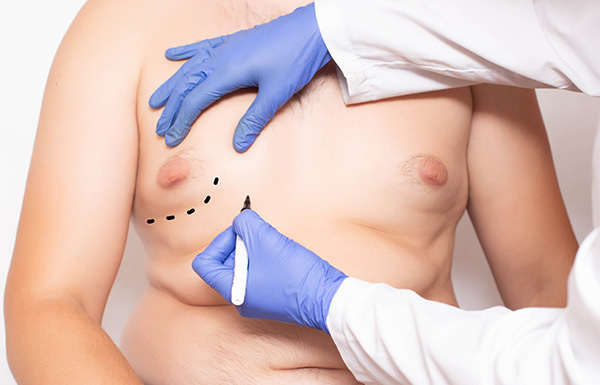 La chirurgie de gynécomastie peut réduire la taille des seins.