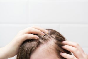 Greffe de cheveux quand