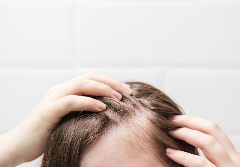 Greffe de cheveux quand